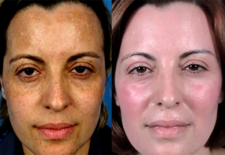 A imagem acima é do antes e depois de uma paciente que recorreu ao tratamento.

• Assista ao Gugu na íntegra no R7.com/Play
• Conheça o Fanol, o tratamento estético que promete rejuvenescer a pele em até 20 anos
• Confira como ficaram as peles dos participantes que passaram por tratamento rejuvenescedor

