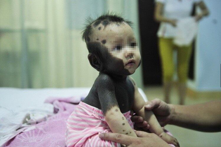 Outro caso é da menina Wang Xinyan que nasceu na província de Sanming, na China, em 213, com diversas manchas pretas em seu corpo