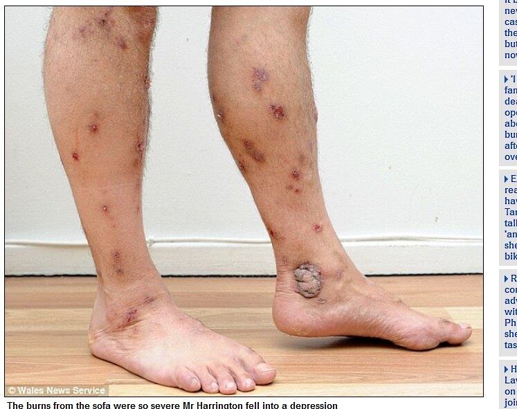 



Harrington conta que todas as vezes que sentava na poltrona sua pele ficava intoxicada.

— Sentia
meu corpo queimar como se alguém tivesse colocado fogo em mim. No meu
trabalho, precisei cobrir os meus braços com ataduras, pois me sentia
envergonhado quando os clientes olhavam para as feridas


