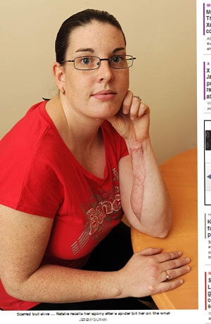 Natalie Hemme, de 31 anos, quase morreu por causa de uma aranha