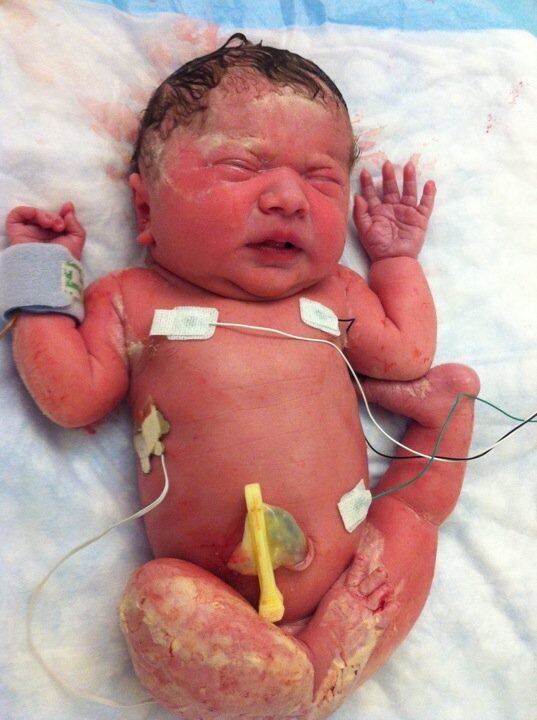 A menina faz fisioterapia e os seus músculos começaram a
proteger os ossos, o que significa que as fraturas ficam cada vez mais raras