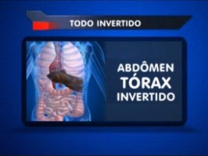 Demonstração da síndrome rara que Vicente tem