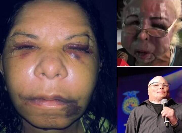 Recentemente, o mexicano Hugo Hernandez virou polêmica após divulgar suas fotos completamente deformado após injetar óleo de bebê em seu rosto.
Além dos procedimentos estéticos malsucedidos, muitas pessoas sofrem com rostos e corpos transformados após acidentes e até mesmo doenças. Veja a seguir histórias chocantes!