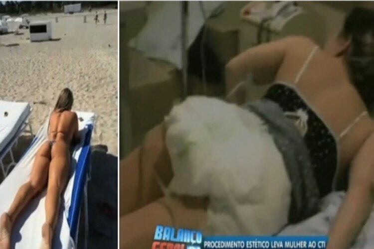 Vânia ficou com várias sequelas e precisará de plástica nos glúteos para corrigir o problema