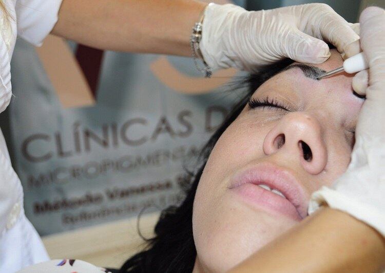 De acordo com a dermomicropigmentadora Vanessa Silveira, que realizou o procedimento, é normal a cliente sentir uma ardência na região enquanto o aparelho é usado para remover a tatuagem.