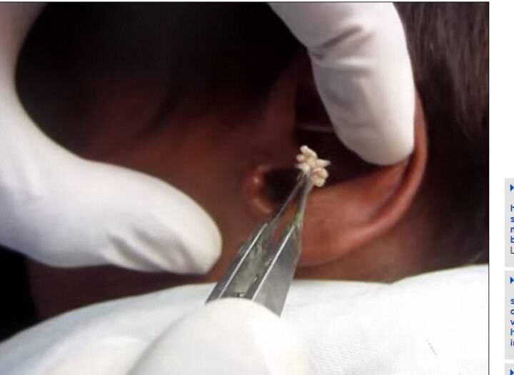 Um jovem teve que passar por um procedimento
nojento e inusitado. Sofrendo com uma infestação de larvas em seu ouvido, o paciente teve
que ir até o médico para tirar, um por um, os intrusos com uma pinça. As
informações são do site DailyMail