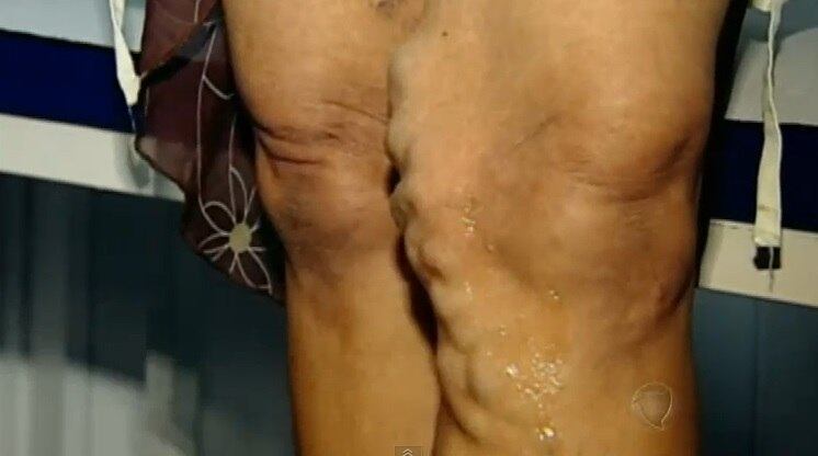 A técnica consiste em aplicar uma substância esclerosante chamada Poidocanol, em forma de espuma, diretamente nas varizes, até que estas desapareçam


No R7 Play, você pode assistir ao Fala Brasil na íntegra! Clique e experimente de graça!

