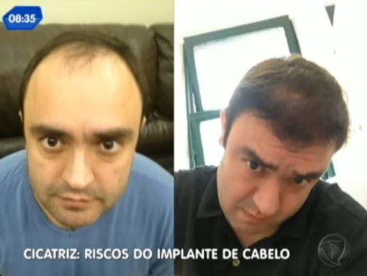 O transplante capilar é o terceiro procedimento mais procurado pelos
homens, segundo a Sociedade Brasileira de Cirurgia Plástica
+ Implante capilar: conheça os riscos do procedimento