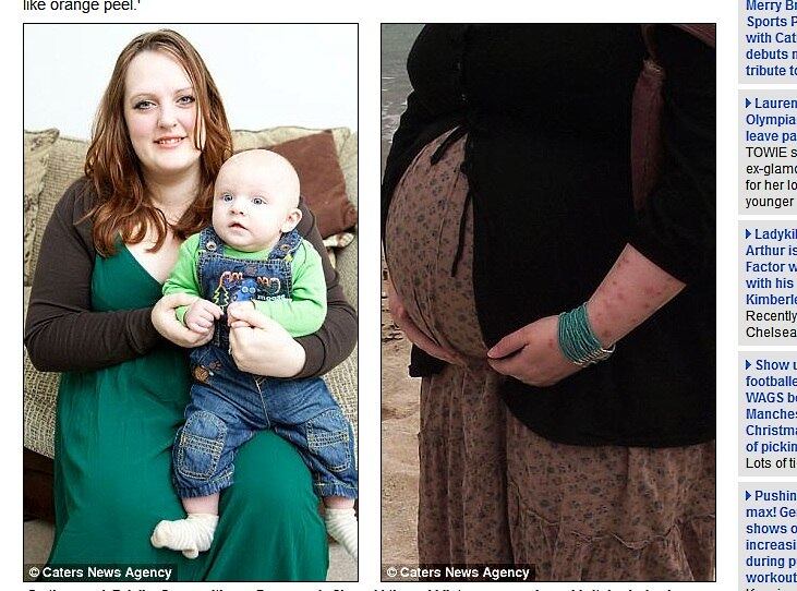 A britânica Zuleika Closs, de 26 anos, desenvolveu uma alergia rara ao seu próprio filho.
Na 20ª semana de gestação, várias bolhas nasceram pelo seu corpo causando
coceira e o diagnóstico foi herpes gestacional