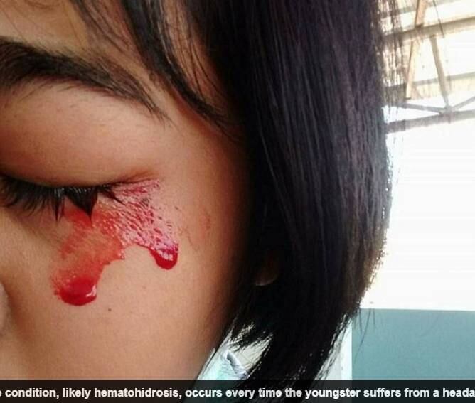 Os médicos suspeitam que se trata
de hematidrose, que é uma condição extremamente rara que faz com que os doentes
transpirem sangue