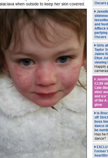 

De acordo com os médicos, uma queda mínima na temperatura
ambiente poderia causar um choque anafilático potencialmente fatal na menina.
Isso significa que Hollie está proibida de nadar, tomar banhos gelados e até
mesmo saborear um sorvete.

 



Garoto alérgico posta fotos chocantes de seu rosto deformado