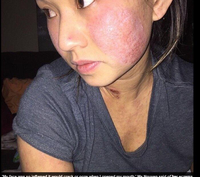 







As feridas na pele de Christine Nguyen eram tão graves que ela mão conseguia se mover e até mesmo comer havia se tornado difícil. A complicação era tanta, que a jovem chegou até a pensar em suicídio. De acordo com informações do site DailyMail,  ela teve de pedir demissão do emprego











































































































































































































