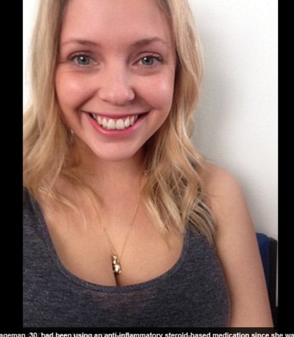 Segundo ela, a dose do remédio era aumentada a cada vez que ia ao dermatologista, porque o corpo estava reagindo contra o medicamento.

— Minha pele estava viciada no remédio, e assim que eu parei de usar a reação do meu corpo foi extrema
