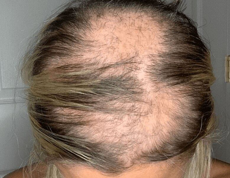 Foram muitos anos sofrendo com a condição, até então desconhecida. A Alopecia areata causa a perda de cabelo em várias partes do couro cabeludo, e impede os fios voltem a crescer naturalmente 