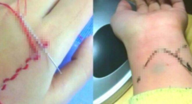 Imagens de bordados costurados na pele já foram publicadas em redes sociais