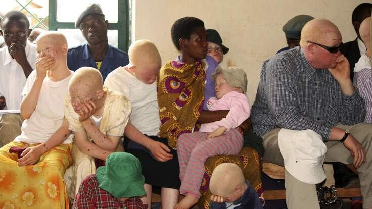 "Conjunto completo" de partes do corpo de albinos pode ser vendido por cerca de R$ 291 mil na Tanzânia (FOTO ILUSTRATIVA)