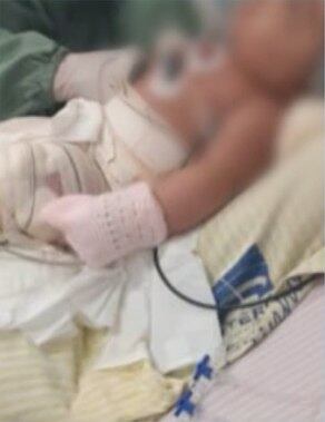 Juliana teve 38% do corpo queimado