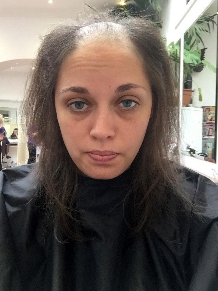 Foram dez longos anos, bem maiores do que os cabelos perdidos neste período, mas Ruth Sweet, de 25 anos, finalmente superou uma doença baseada na compulsão por arrancar fios do próprio couro cabeludo