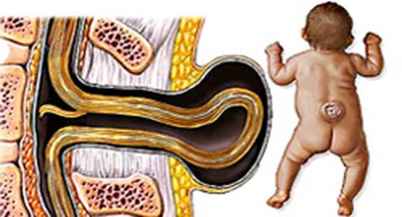 Espinha bífida é uma falha no desenvolvimento da coluna vertebral e da medula espinhal.
Isso deixa uma abertura na coluna vertebral. Todos os anos cerca de 365 mulheres grávidas na Inglaterra e País de Gales têm fetos diagnosticados com a doença
Vídeo: Grande parte da população sofre com problema de coluna
Abusar do silicone pode provocar dores na coluna, pescoço e até estrias
“Dor nas costas pode indicar a presença de várias doenças”, alerta médico