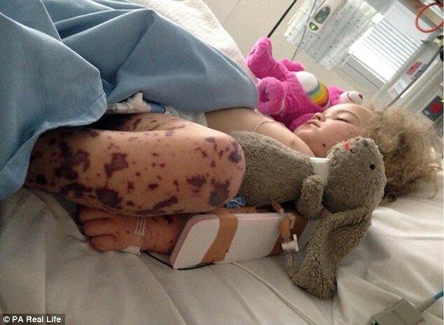 Segundo o relato da mãe, a menina parecia bem, até acordar com febre em uma noite fria de agosto de 2015. Como os pais já estavam com gripe, acreditaram que a filha havia contraído o vírus, e decidiram levá-la para o hospital. No entanto, se surpreenderam ao tentar retirá-la da cama:

— Quando encostamos nas pernas de Jazmyn, ela começou a gritar desesperadamente de dor. Não podíamos nem encostar nela. Eu até havia notado algumas manchas em suas pernas, mas pensei que fossem hematomas de quedas. Foi quando percebemos que havia algo errado 