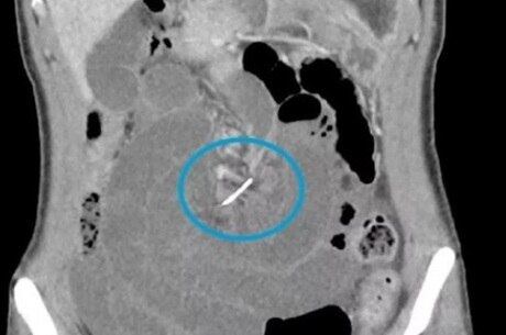 Durante um período de sete anos nos Estados Unidos, os cirurgiões deixaram para trás 770 objetos