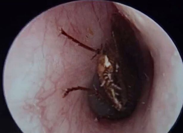 Inseto tinha dois centímetros e caminhava em direção ao tímpano