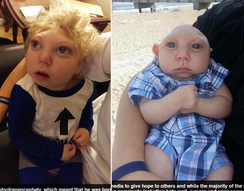 O pequeno Buell Jaxo, que nasceu sem a metade do crânio e apenas 20% do cérebro, superou todas as expectativas médicas e completa dois anos e meio de idade. Ele tem microhidranencefalia, condição raríssima