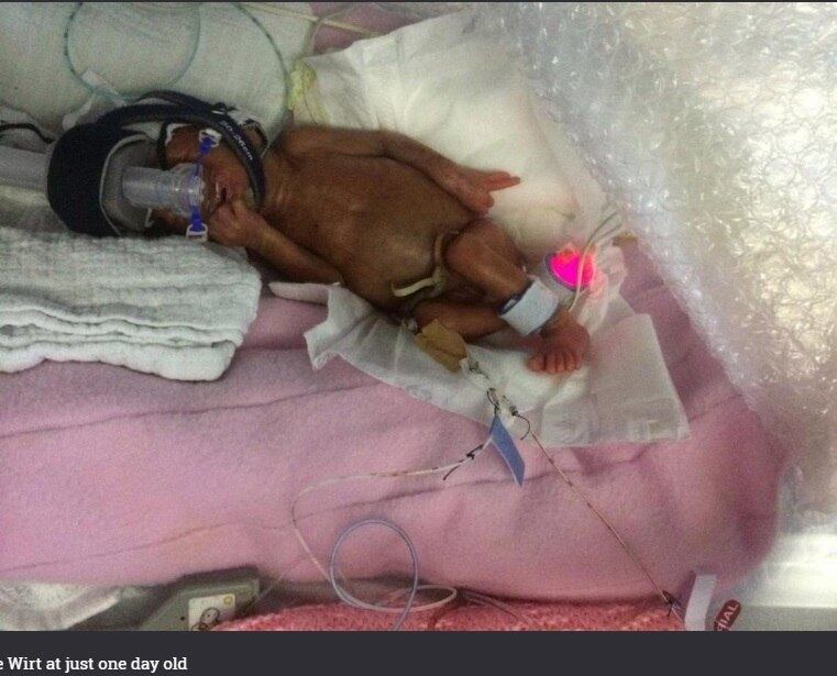 Quando nasceram com 24 semanas de vida, as gêmeas eram menores
que a mão da mãe Caroline. Na época, os médicos disseram que era incrivelmente improvável
que as duas meninas sobrevivessem