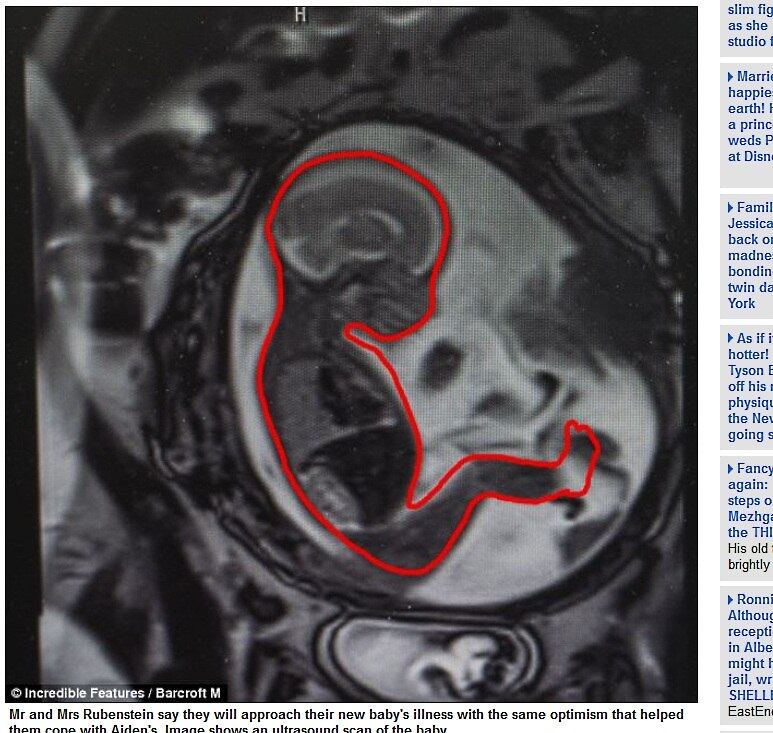 

O
filho mais velho foi submetido a um tratamento sob os cuidados da pediatra
Marieta Reynolds.



— Em 30 anos de trabalho, eu nunca vi
uma família com duas crianças que sofrem da mesma condição