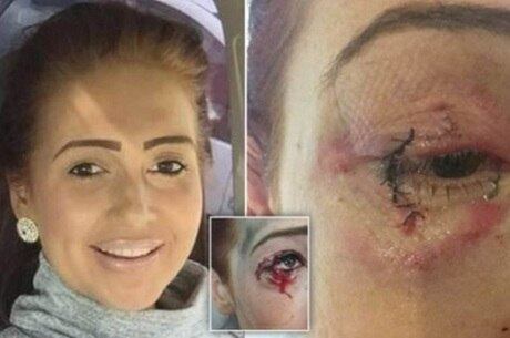 Kirby Sheenl sofreu após cigarro eletrônico explodir