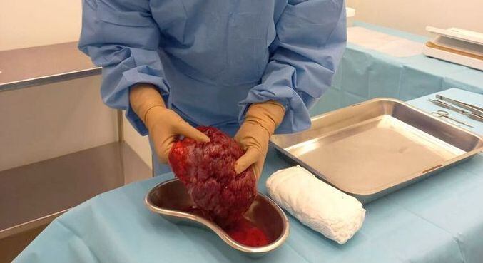 Curativo biológico à base de placenta