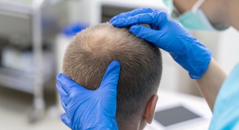 Minoxidil tomado via oral torna o tratamento mais eficiente