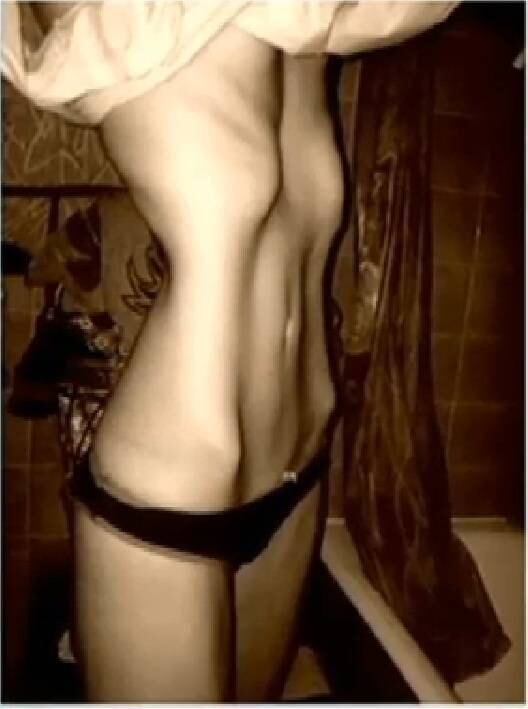 

De acordo com a endocrinologista Cintia Cercato, a principal
característica da pessoa anoréxica é estar magra e acreditar que ainda está
acima do peso.

— O que é doentio é atingir peso muito baixo e
ainda assim se enxergar gordo.  A pessoa
tem distorção de sua imagem corporal