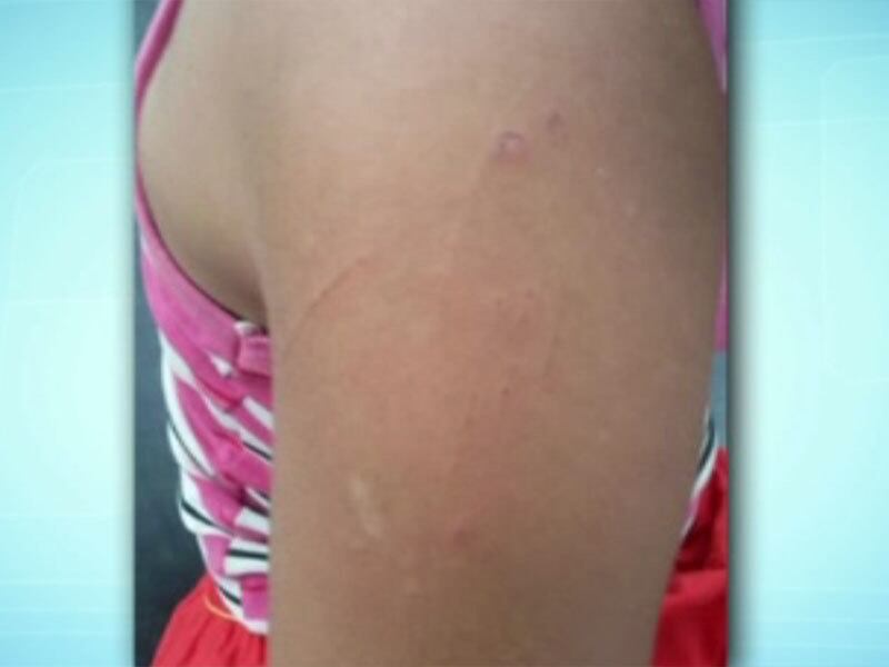 Criança tinha hematomas pelo corpo