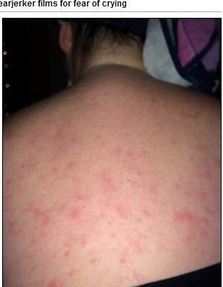 Quando completou 20 anos, percebeu que seus problemas poderiam estar relacionados à água. 


― Toda vez que bebia água, minha garganta se fechava e
começava a ter muita falta de ar.



Depois de vários anos de sofrimento, ela finalmente foi
diagnosticada com alergia severa a água. Ela foi internada após tomar uma banho longo