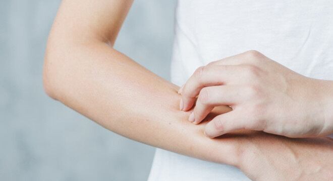 Sarampo pode levar à morte principalmente em crianças menores que 1 ano