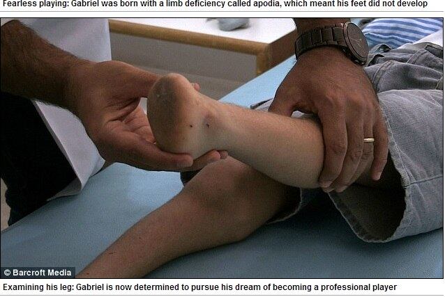 Mesmo sem ter os pés, Gabriel é um exemplo de superação.
Segundo a mãe Sandra, “ele começou a andar aos 10 meses, antes mesmo de falar.
Ele é incrível”