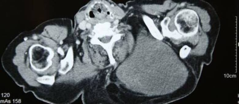 Nenhum hospital havia aceitado tratar a idosa de 65 anos
