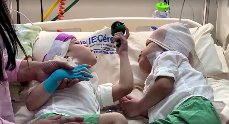 Gêmeos puderam deitar-se frente a frente pela primeira após a operação