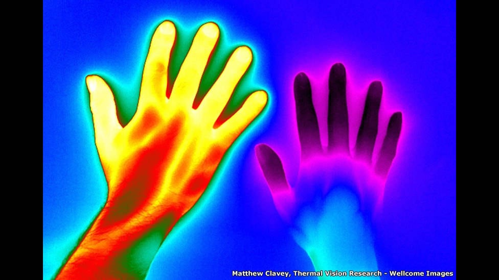 As belezas da medicina foram retratadas artisticamente por fotógrafos que participam do Wellcome Image Awards — o concurso anual de fotografia médica. Vinte finalistas concorrem ao prêmio de 2016, que vai ser entregue ao vencedor no dia 15 de março. 

A imagem acima foi tirada por Matthew Clavey com uma câmera termal que registra a temperatura do corpo. A foto mostra a mão de duas pessoas: a da esquerda está saudável, e a da direita sofre da doença de Raynaud — síndrome que afeta o fluxo sanguíneo das extremidades do corpo. As duas mãos foram submersas em água fria por dois
minutos antes do exame, e a mão saudável voltou a esquentar muito mais
rapidamente.

Segundo a presidente do painel julgador, a diretora de imagens Catherine Draycott, a imagem é impressionante porque mostra de forma prática como a doença afeta a circulação de um paciente. 
