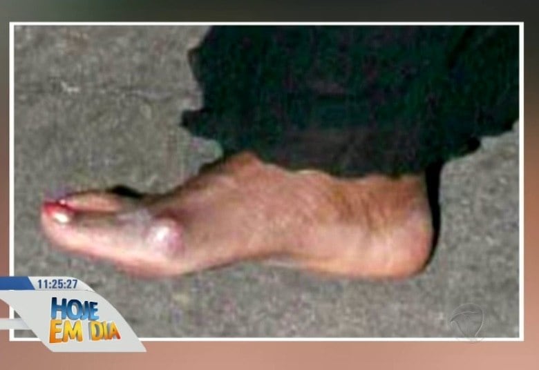 Ela já foi embora de uma festa descalça para aliviar a dor
causada pelos joanetes

• Assista ao Hoje em Dia na íntegra? Acesse o R7.com/Play 



