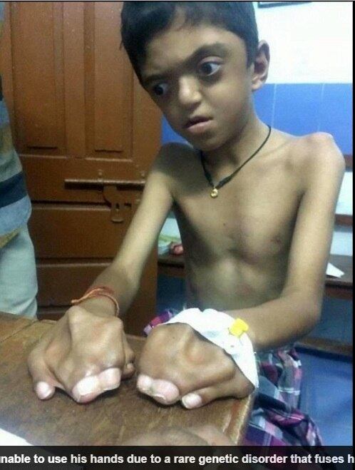 Um menino de oito anos sofre de síndrome de Apert, doença genética rara que deixa os dedos das mãos e dos pés unidos. Além disso, ele sofre com desenvolvimento anormal da cabeça. Para tenta salvar o filho, os pais venderam todos os pertences para conseguir pagar o tratamento do dele, mas ainda não têm o valor suficiente