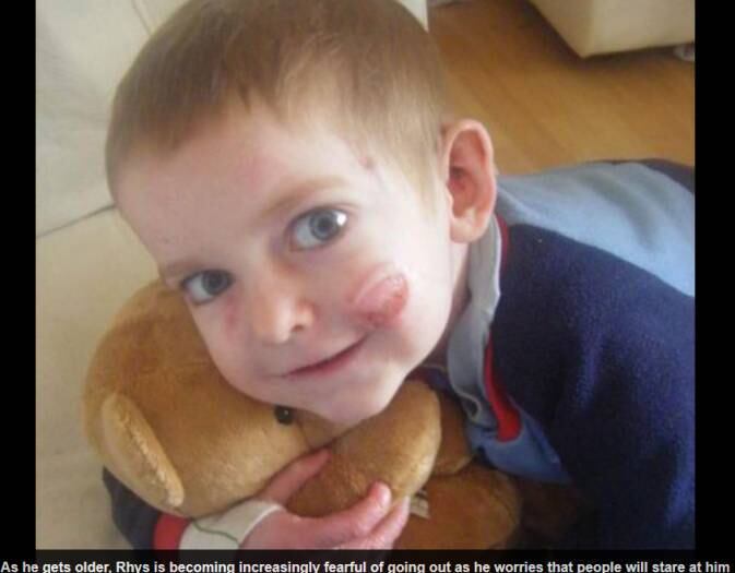 De acordo com a publicação, a
condição de Williams é incurável. A pele do menino é tão sensível que, ao menor
contato, bolhas se formam e se transformam em feridas