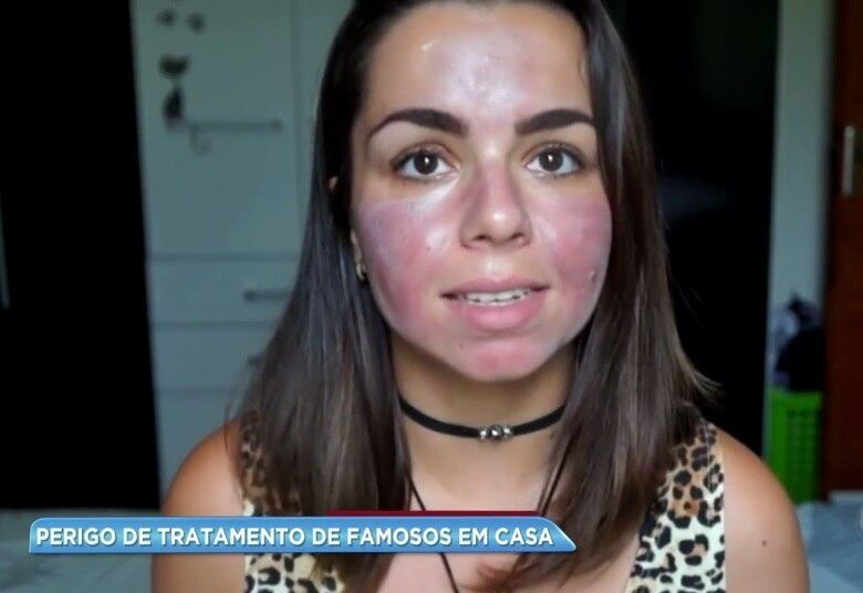 Em vídeo feito para a internet, a blogueira explica que comprou o aparelho por um preço baixo, e usou uma pomada anestésica antes de aplicá-lo sobre a pele, deixando-a dormente