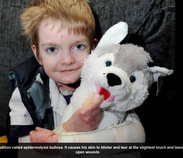 O valente britânico Rhys Williams, de oito anos de idade, tem uma doença rara que provoca bolhas em seu corpo da cabeça aos pés, chamada epidermólise bolhosa. Por causa desta condição, ele sente muita dor e não pode sequer abraçar seus pais