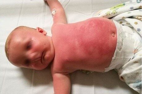 O bebê sofreu queimaduras após aplicação de protetor solar