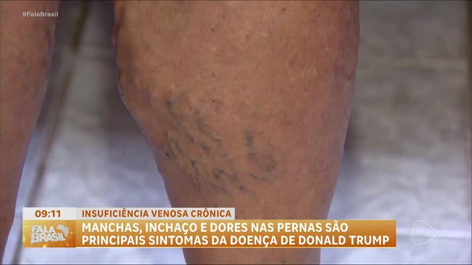 Insuficiência venosa crônica: entenda a condição que afeta milhões de pessoas