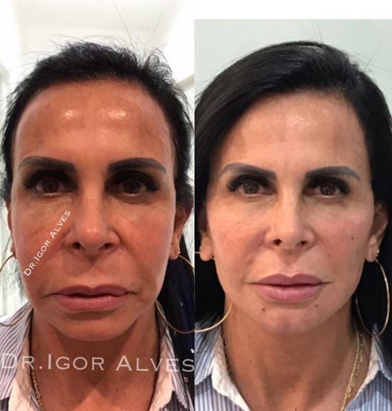 Gretchen-harmonização facial