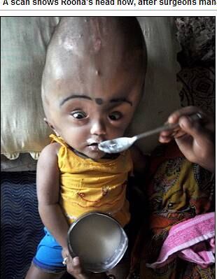 Roona, que teve a circunferência de sua cabeça diminuída para
54cm, ainda não consegue andar devido ao peso de sua cabeça. Mas, graças ao
procedimento, a menina já é capaz de engatinhar, comer e dormir, coisas que não
podia realizar antes