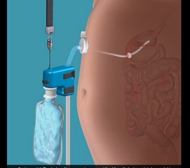 Um novo aparelho que
deixa as pessoas comerem o quanto quiserem sem engordar está próximo de char ao
mercado no Reino Unido. De acordo com informações do site DailyMail, é possível
“comer como um porco” e depois “limpar” o estômago com o aparelho. A comida que
ainda não foi digerida pode ser retirada antes que o organismo consuma aquele
alimento